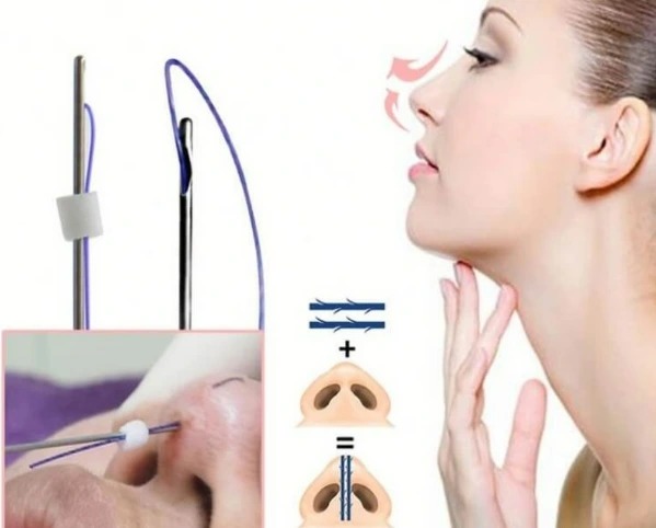 Khái niệm về căng chỉ mũi