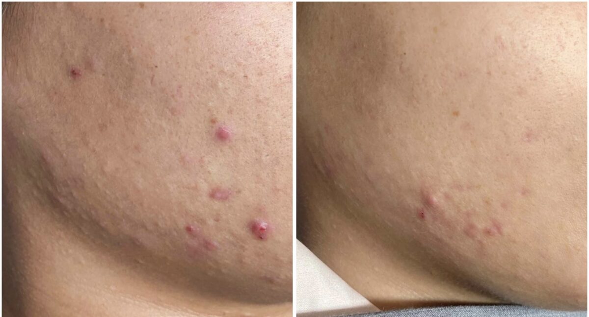 Lấy nhân mụn giúp loại bỏ mụn không để lại sẹo