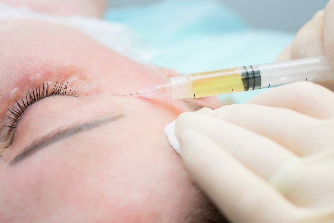 PRP therapy for melasma treatment