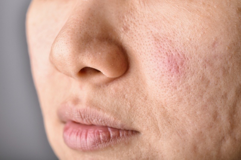 Lỗ chân lông to tạo điều kiện cho bụi bẩn và bã nhờn tích tụ, dễ gây mụn
