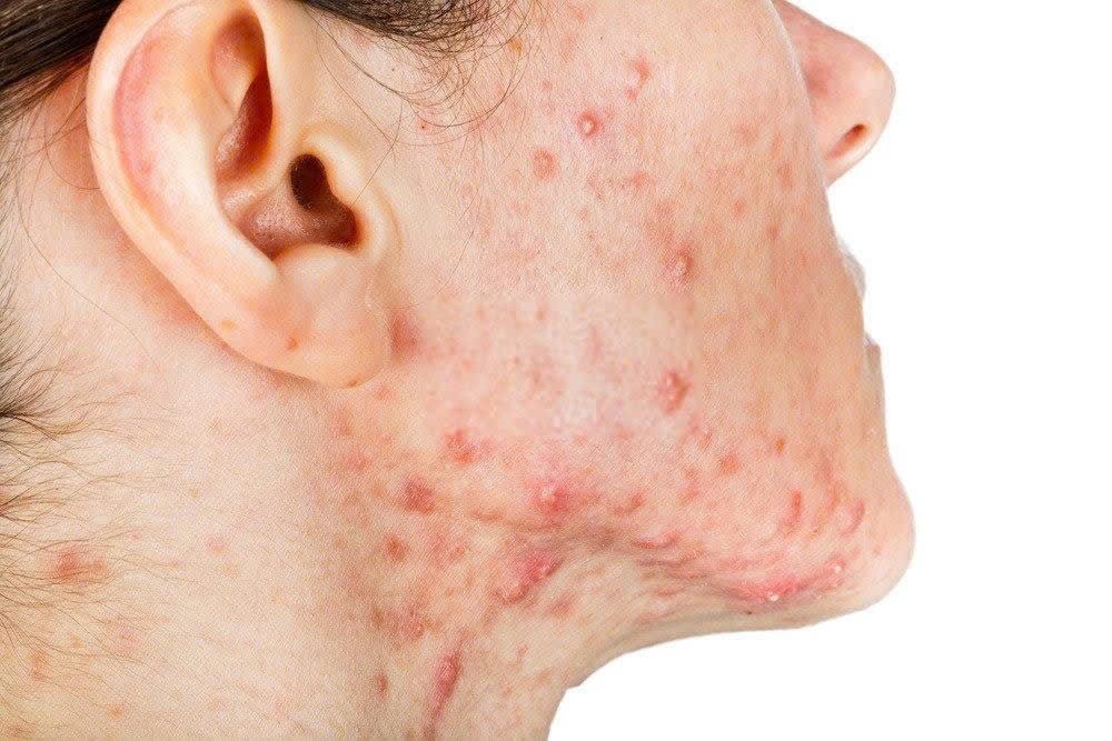 Mụn bọc là tình trạng nặng của mụn trứng cá