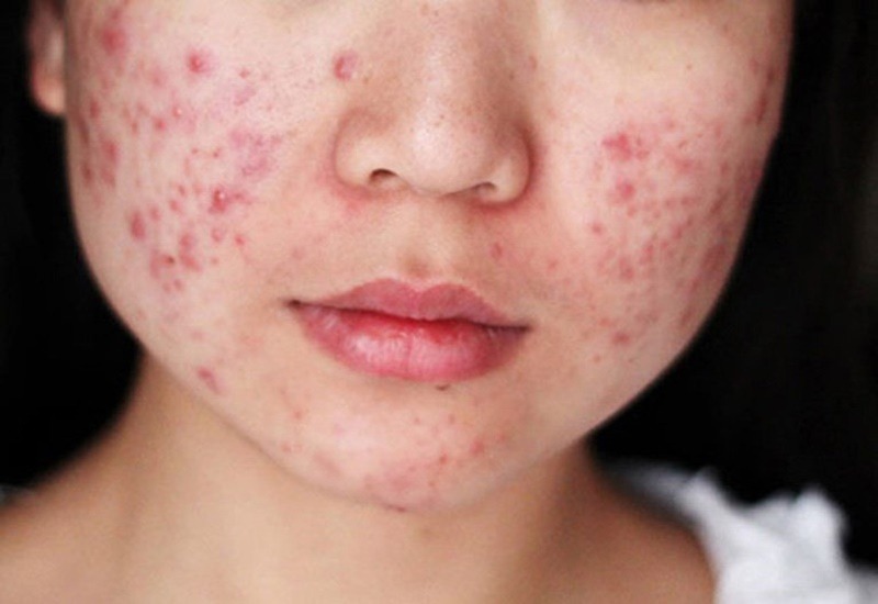Mụn là bệnh da liễu phổ biến gây mất thẩm mỹ cho làn da