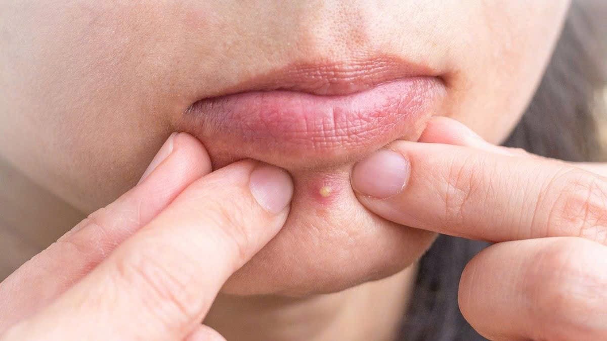 Mụn mủ xuất hiện như thế nào?