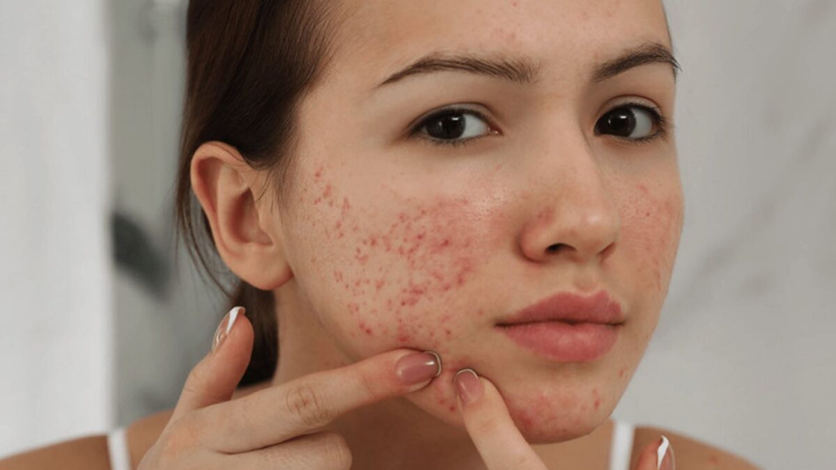 Mụn viêm đỏ xuất hiện ở 2 bên má
