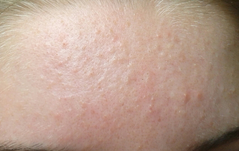 Nguyên nhân gây ra mụn ẩn?