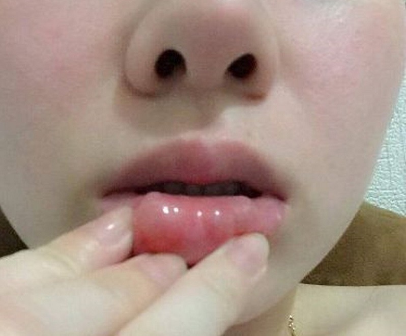 Nguyên nhân gây ra tình trạng tiêm filler bị vón cục
