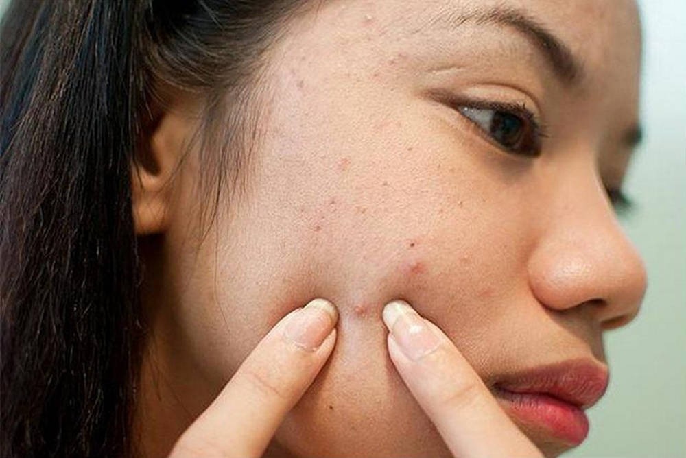Nguyên nhân gây sẹo rỗ