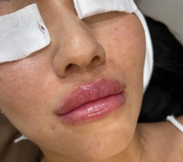 Nguyên nhân tiêm filler bị sưng tấy đau nhức