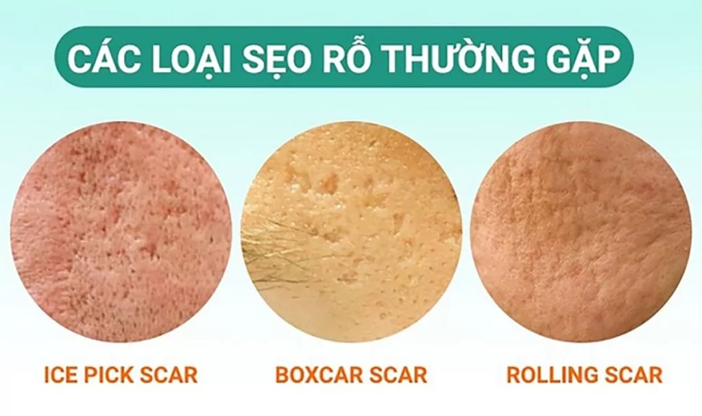 Phân loại các dạng sẹo rỗ thường gặp hiện nay