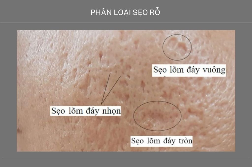 Phân loại các dạng sẹo rỗ thường gặp hiện nay
