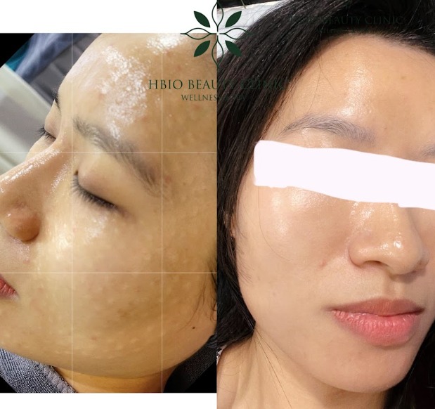 Phương pháp Chemical Peels (Peel da)