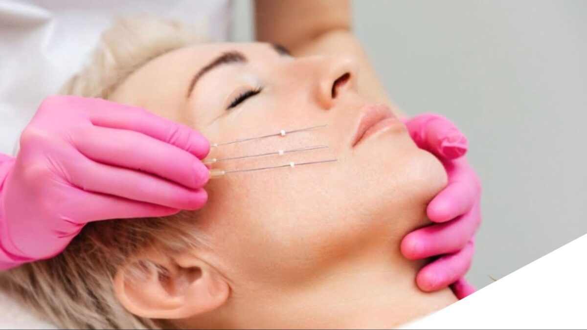 Quy trình căng chỉ nâng rãnh miệng cằm tại Hbio Clinic
