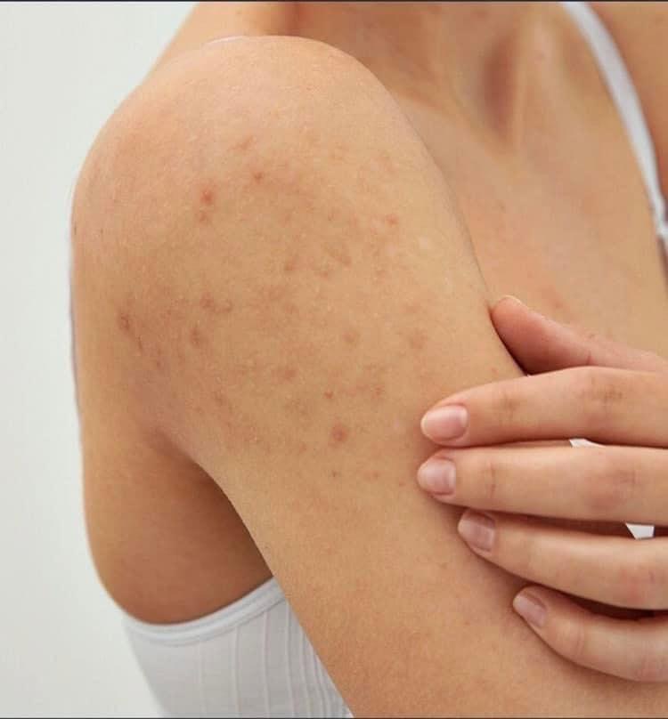 Thay đổi nội tiết tố là một trong những nguyên nhân phổ biến gây mụn