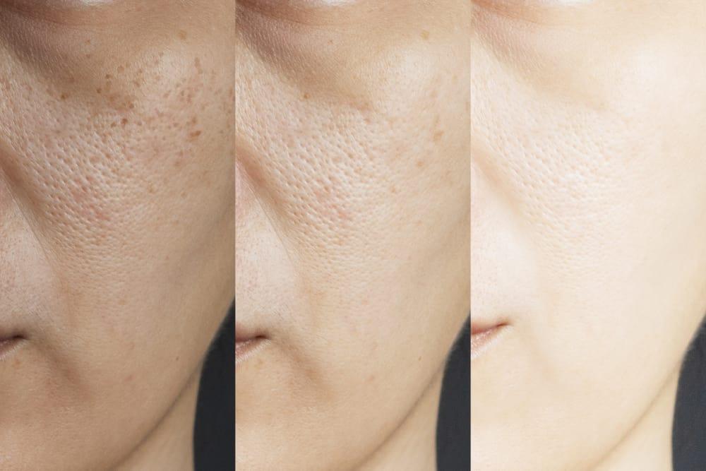 Thu nhỏ lỗ chân lông, cải thiện kết cấu da