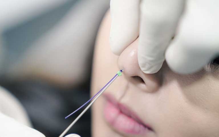 Thực hiện phương pháp căng chỉ mũi