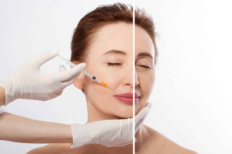 Dermal fillers – instant skin rejuvenation