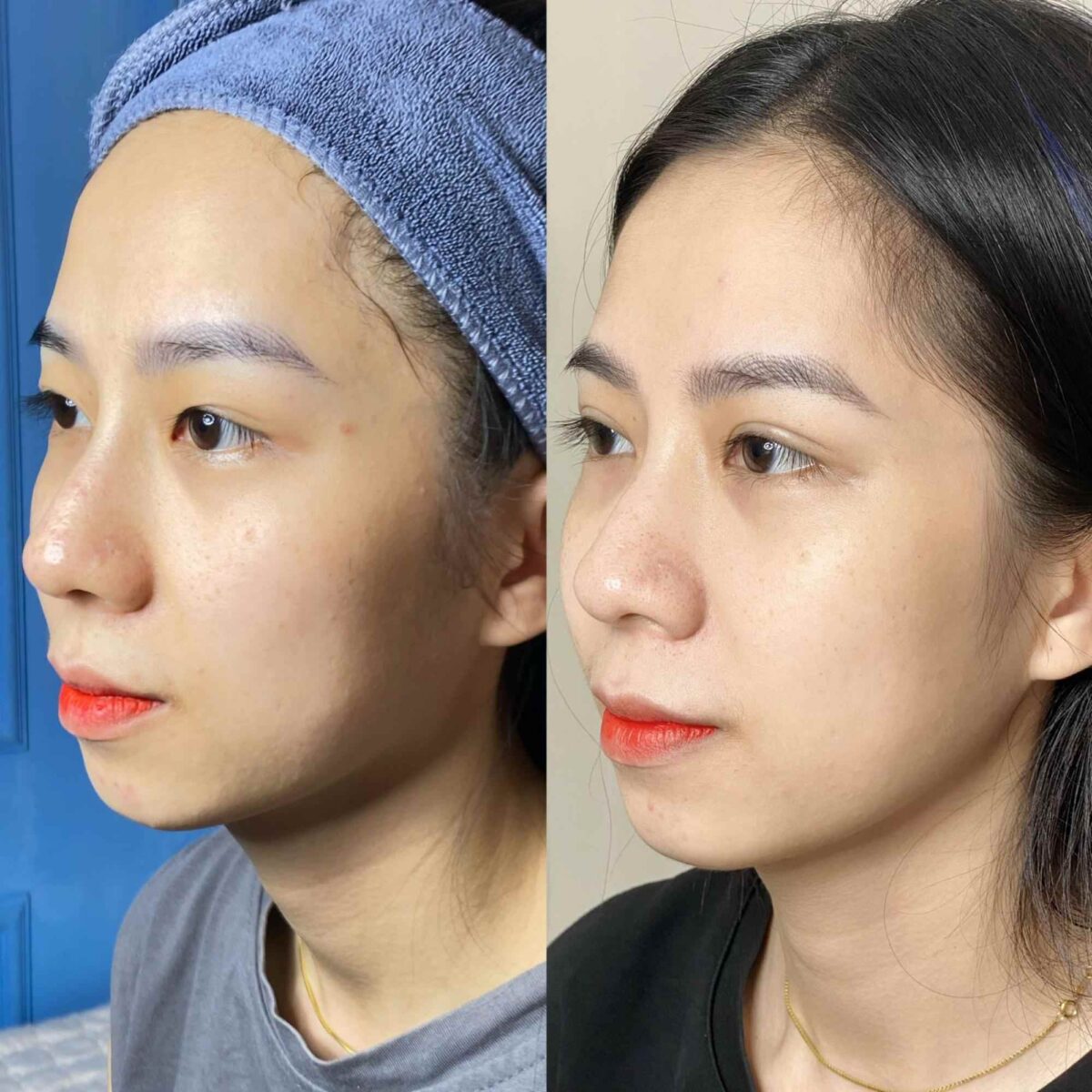 Tiêm collagen giúp làn da trẻ hóa