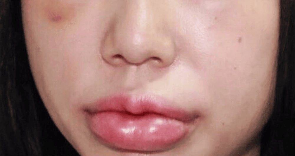 Tiêm filler bao lâu hết sưng?