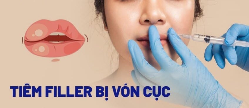 Tiêm filler bị vón cục có sao không?
