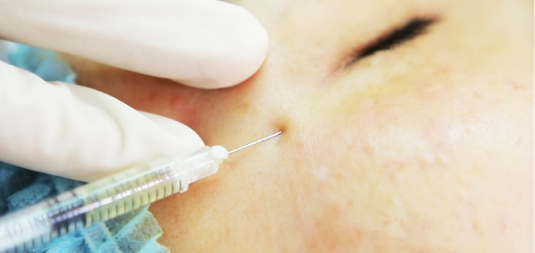 Tiêm filler lấp đầy sẹo lỗ