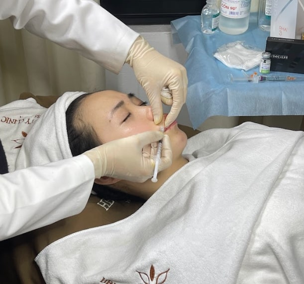 Tiêm filler môi bao lâu thì hết sưng