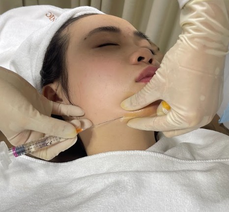 Tiêm filler tạo hình cằm V-line