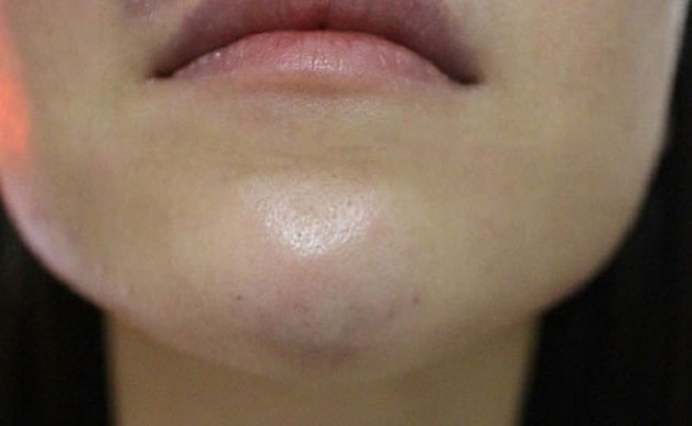 Tiêm quá nhiều filler