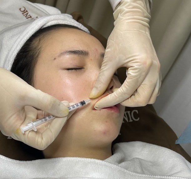 Tìm hiểu cách căng mọng môi - tiêm filler môi