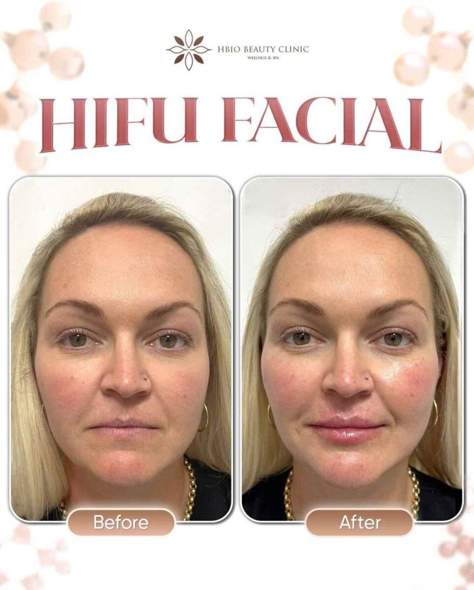 Hình ảnh trước và sau khi điều trị bằng công nghệ hifu