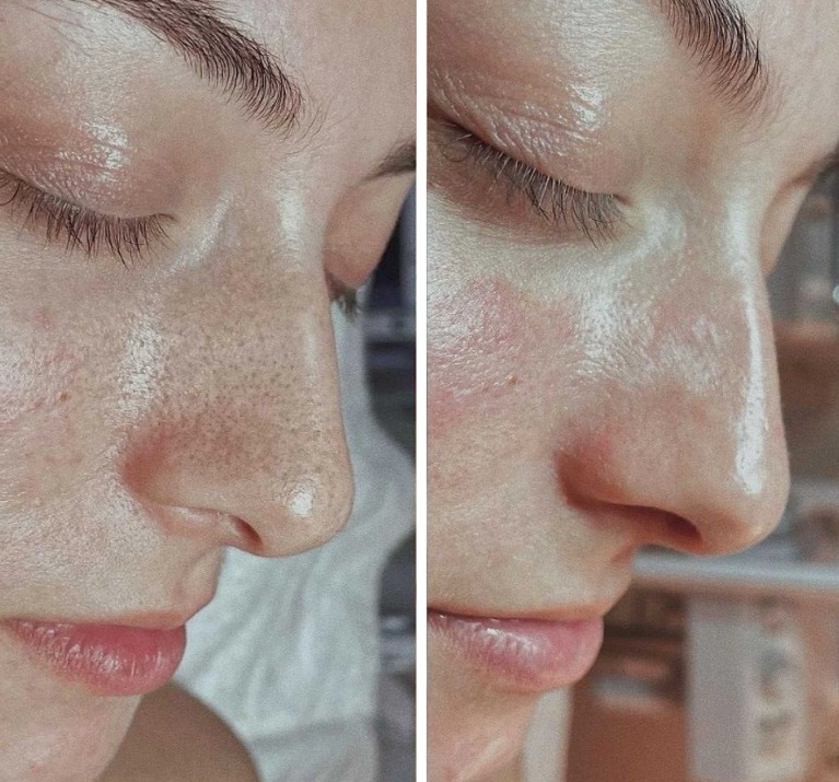 Trước và sau khi dùng dịch vụ Hydracial