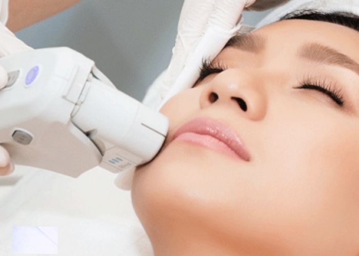 Ứng dụng laser giảm mỡ nọng cằm bằng tại HBIO