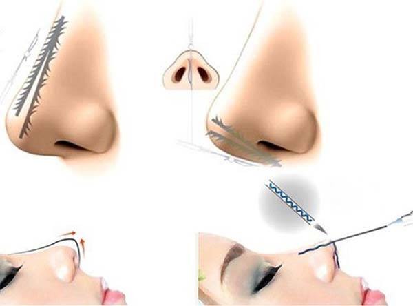 Ưu điểm vượt trội căng chỉ mũi
