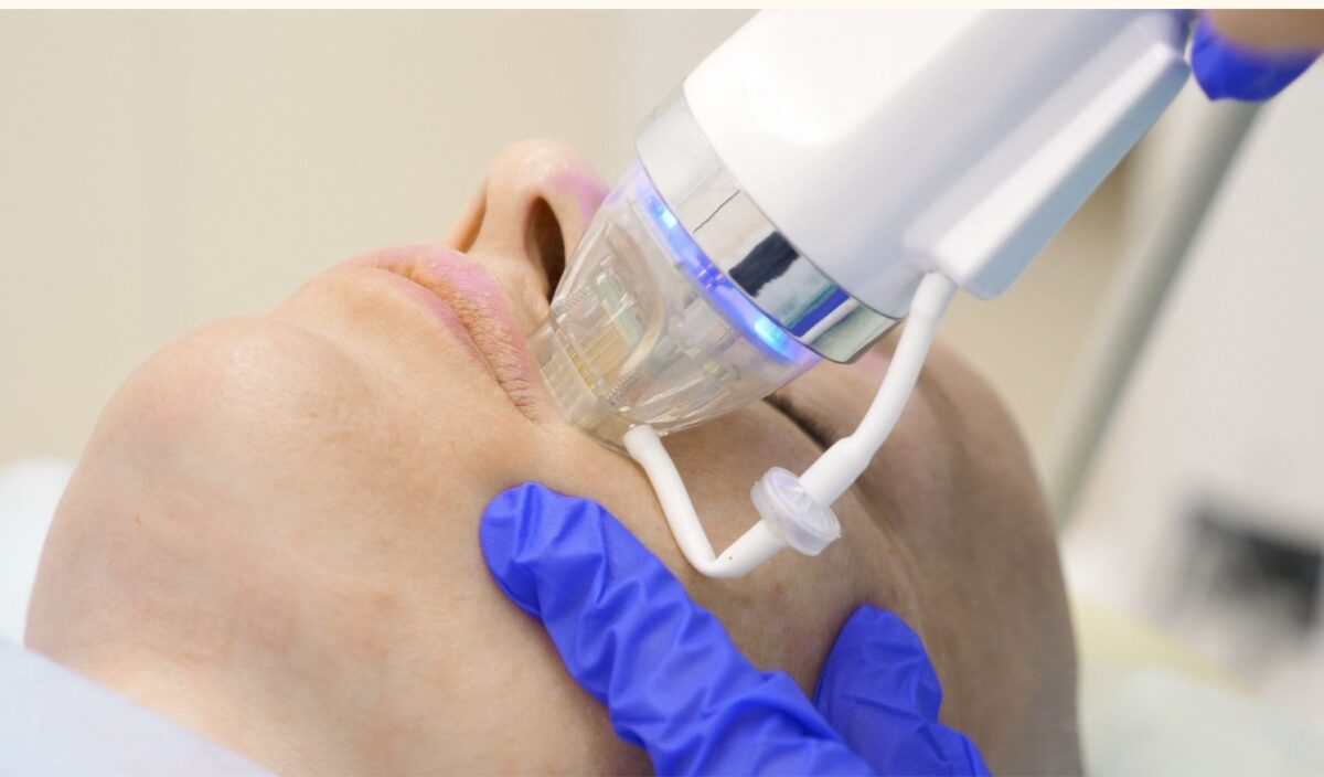 Ưu, nhược điểm của công nghệ needle RF
