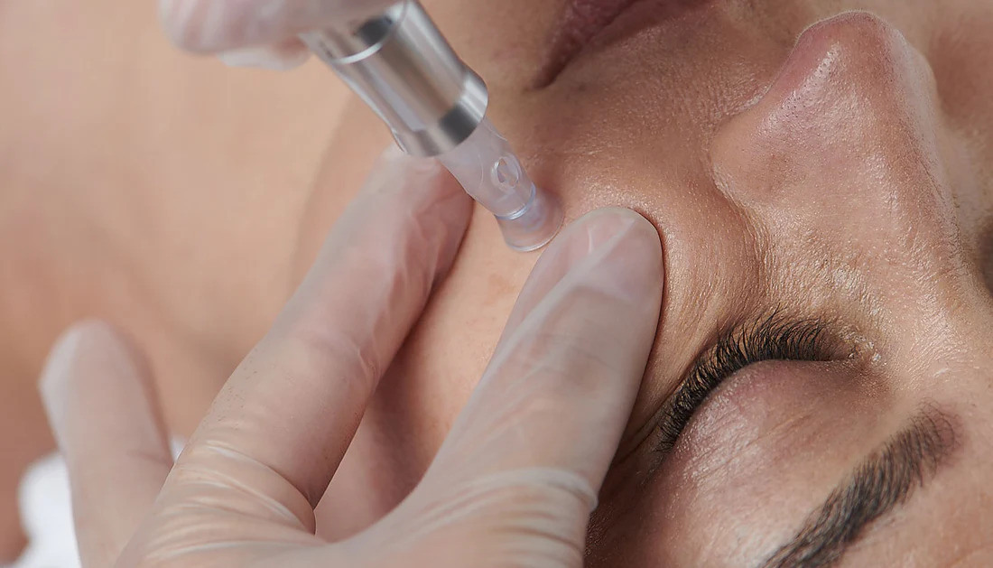 Ưu, nhược điểm của công nghệ skin pen (microneeding)