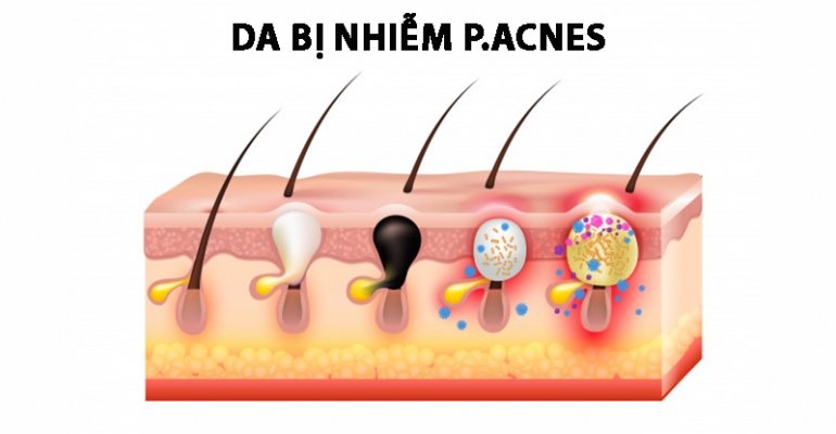 Vi khuẩn P.Acnes gây mụn cho da