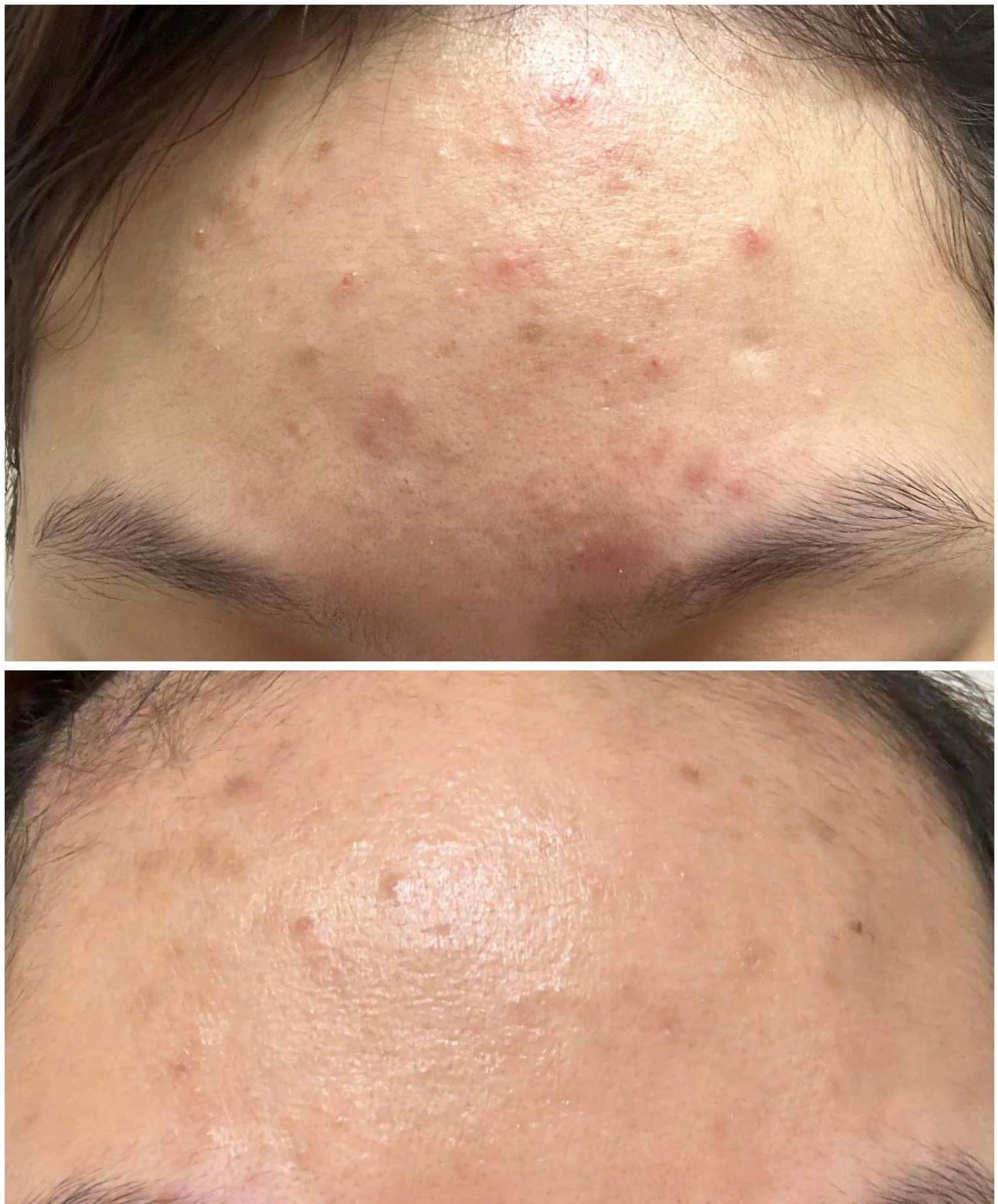Vi kim tảo biển (Algae Peeling)