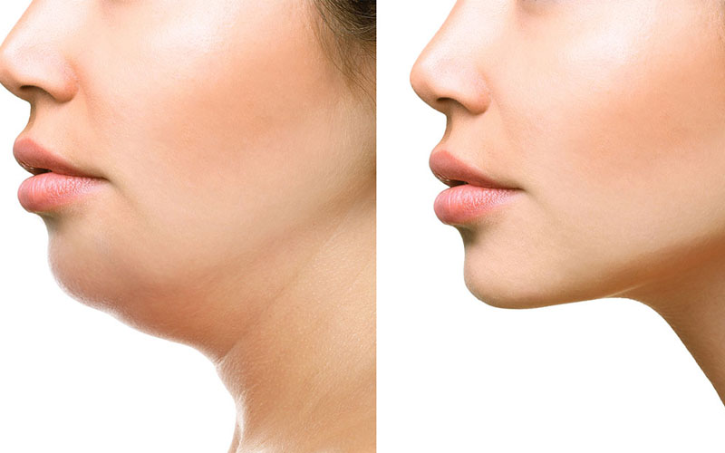 Vì sao bạn bị nọng cằm?