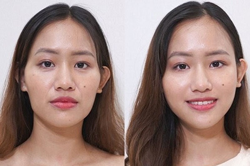 Lượng filler cần tiêm là bao nhiêu?