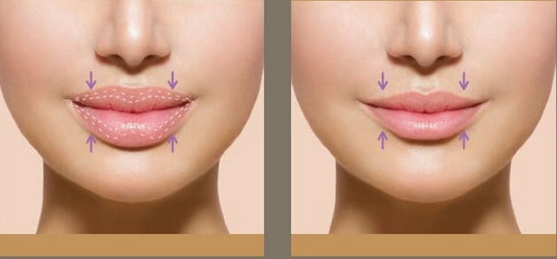 Môi dày tiêm filler được không?