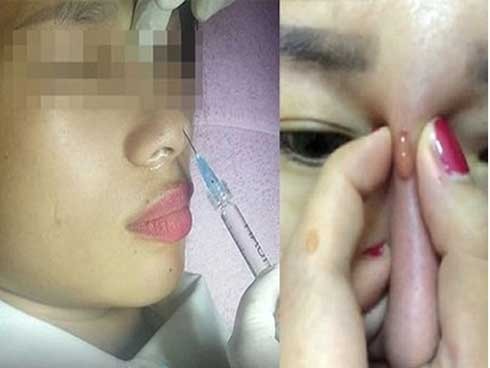 Nguyên nhân gây ra tiêm filler mũi bị tràn