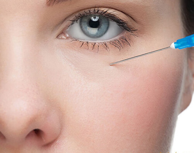 Tiêm filler hốc mắt là một phương pháp thẩm mỹ